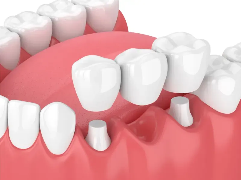 Vollkeramik-Inlays und Kronen aus dem eigenen Dentallabor