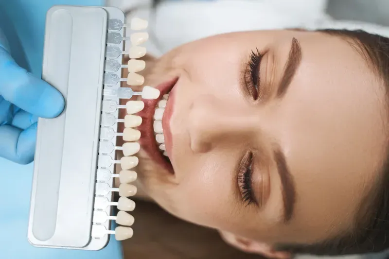 Veneers – hauchdünne Keramik-Verblendschalen für ein schönes Lächeln
